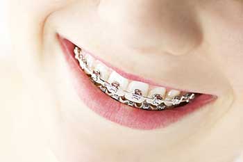 Braces in Racine