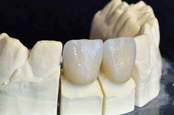 Racine dental Crowns