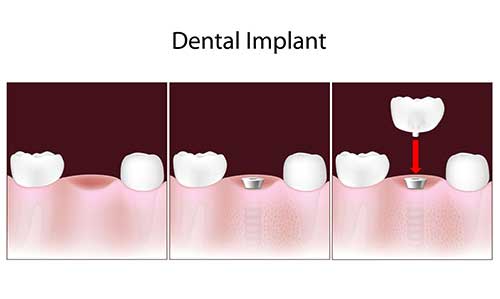 Racine Dental Implants