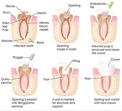 Root Canals in Racine