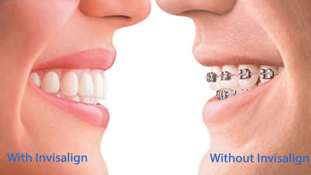 Invisalign® Racine