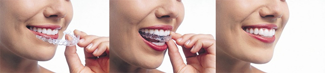 Racine Invisalign